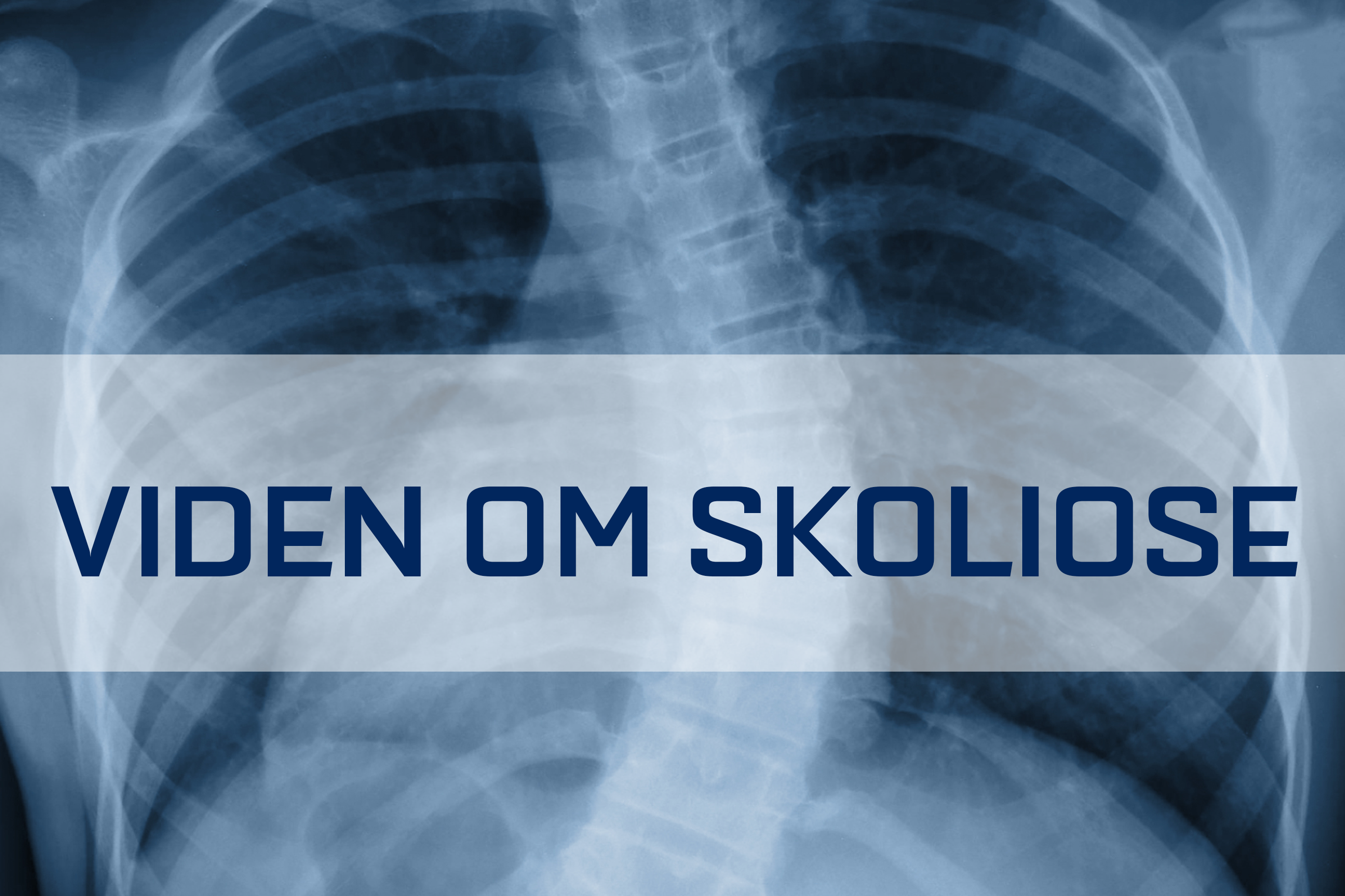 Få nyheder og viden om skoliose.